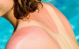 Gia tăng ung thư da vì phơi nắng quá mức