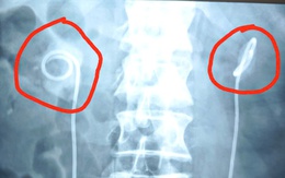 Quên rút ống thông niệu quản suốt 2 năm, người đàn ông biến chứng nặng nề