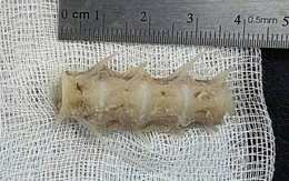 Hóc đoạn xương sống cá 4cm trong cổ, cụ ông 99 tuổi nguy kịch