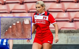 Nữ cầu thủ ‘xinh như tranh vẽ AI’ bị thương vì nhện