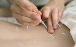 Viện Y tế Quốc gia của Mỹ: châm cứu hiệu quả với đau lưng mạn tính
