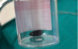 Bé Campuchia bị hóc hạt mãng cầu 20 ngày, được bác sĩ Việt Nam cứu kịp thời