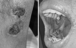 Uống sai liều thuốc da liễu, nhiều người ngộ độc nặng