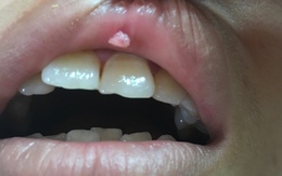 Oral sex tưởng an toàn, cô gái trẻ mắc sùi mào gà ở miệng