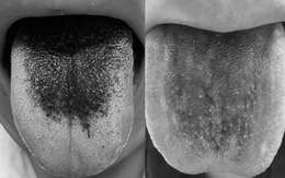 Lưỡi đen bất thường có phải bệnh nguy hiểm?