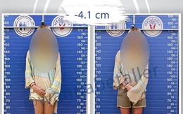 Cô gái 1m73 chi 20.000 USD cắt 4cm xương đùi để mình bớt cao