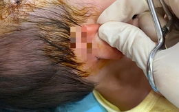 Bé 19 tháng tuổi ở Huế bị chó dữ cắn vào đầu, mặt và cổ