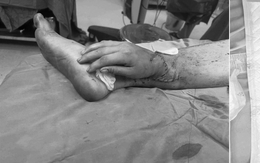 Bàn tay ghép vào chân sản phụ mang song thai đã hồng hào