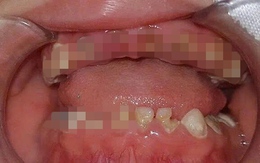 Những ảnh hưởng tới răng, xương hàm, gia đình có trẻ bú bình cần biết