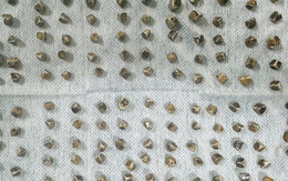 Đau bụng đi khám, người phụ nữ sốc khi bác sĩ lấy ra 130 viên sỏi mật