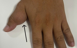 Tưởng 'thịt thừa' ở ngón tay, không ngờ là khối u ăn mòn xương