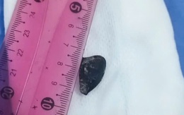 Hạt sapo bị bỏ quên 10 năm trong lòng phế quản