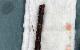 Bé gái 3 tuổi mang cành cây dài 16cm trong bụng suốt 4 tháng