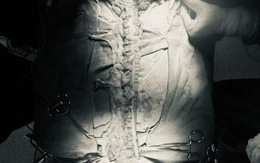 Người đàn ông được tạo hình thực quản bằng đoạn đại tràng