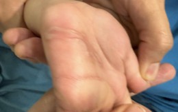 Xuất hiện 'những con đường ngoằn ngoèo kỳ lạ' trong lòng bàn tay trẻ 4 tuổi