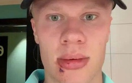 Erling Haaland khâu 3 mũi sau tai nạn hy hữu