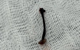 Bé trai chảy máu mũi cả tuần vì con vắt sống ký sinh trong hốc mũi