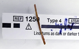 Nuốt que xiên nhỏ gây hậu quả lớn