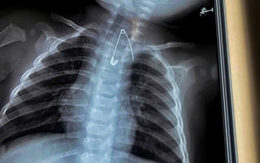 Cứu sống hai em bé nuốt kim băng và cây kẹo mút