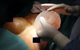 Nguy cơ từ phẫu thuật thẩm mỹ