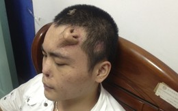 Mũi "mọc" trên trán