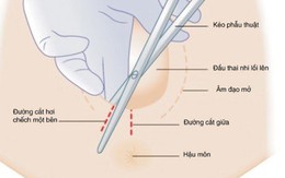 ​Tại sao phải cắt tầng sinh môn khi sinh con?